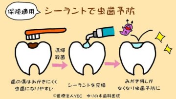 奥歯の溝をシーラントで埋めてむし歯を予防する仕組みを説明した図