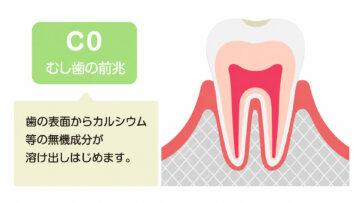 飯田市のおおしか歯科医院が解説するC0のむし歯の前兆。歯の表面で脱灰が始まった状態を示すイラストです。