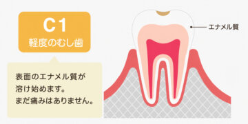 飯田市のおおしか歯科医院が解説するC1の軽度のむし歯。エナメル質に限局した初期むし歯のイラストです。