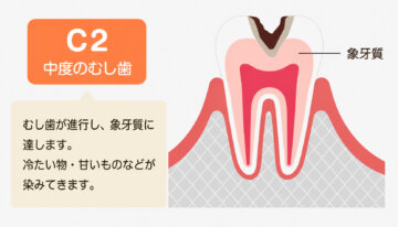 飯田市のおおしか歯科医院が解説するC2の中度のむし歯。象牙質まで進行したむし歯の状態を示すイラストです。