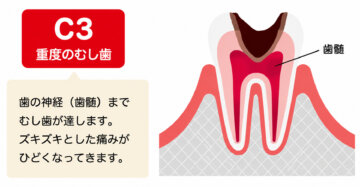 飯田市のおおしか歯科医院が解説するC3の重度のむし歯。歯髄まで達したむし歯の状態を示すイラストです。