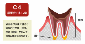 飯田市のおおしか歯科医院が解説するC4の最重度のむし歯。歯冠が崩壊し歯根だけが残った状態を示すイラストです。