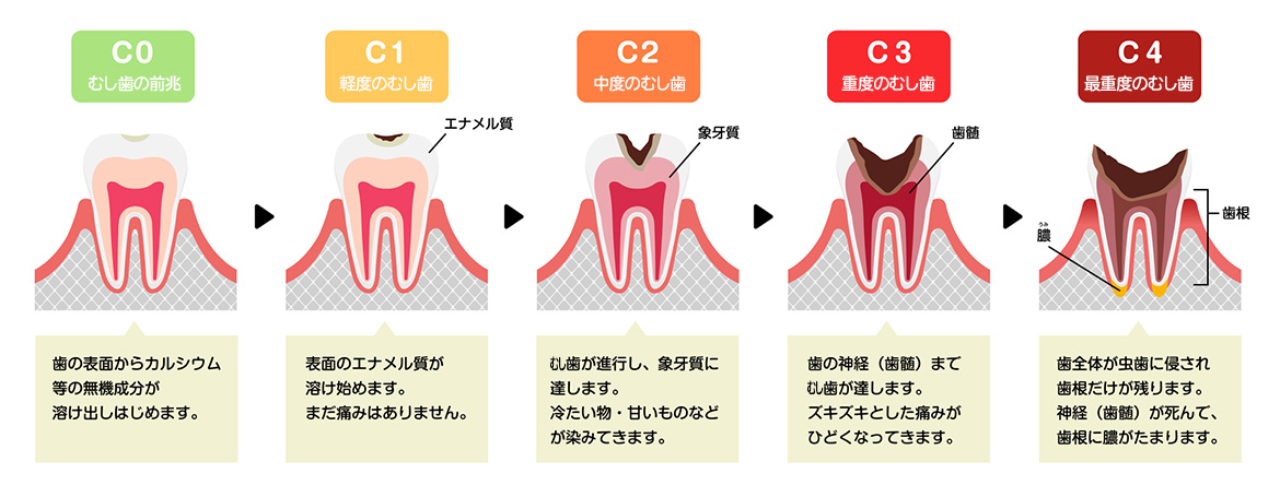 飯田市のおおしか歯科医院が解説するむし歯の進行。C0からC4までの進行段階をわかりやすくまとめたイラストです。