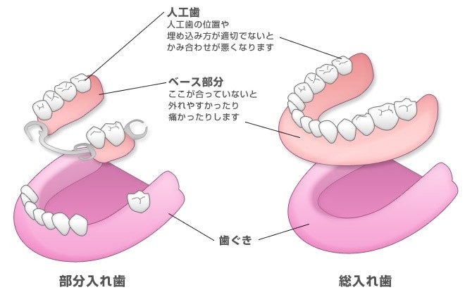 飯田市のおおしか歯科医院が解説する部分入れ歯と総入れ歯の構造や違いを示したイラストです。