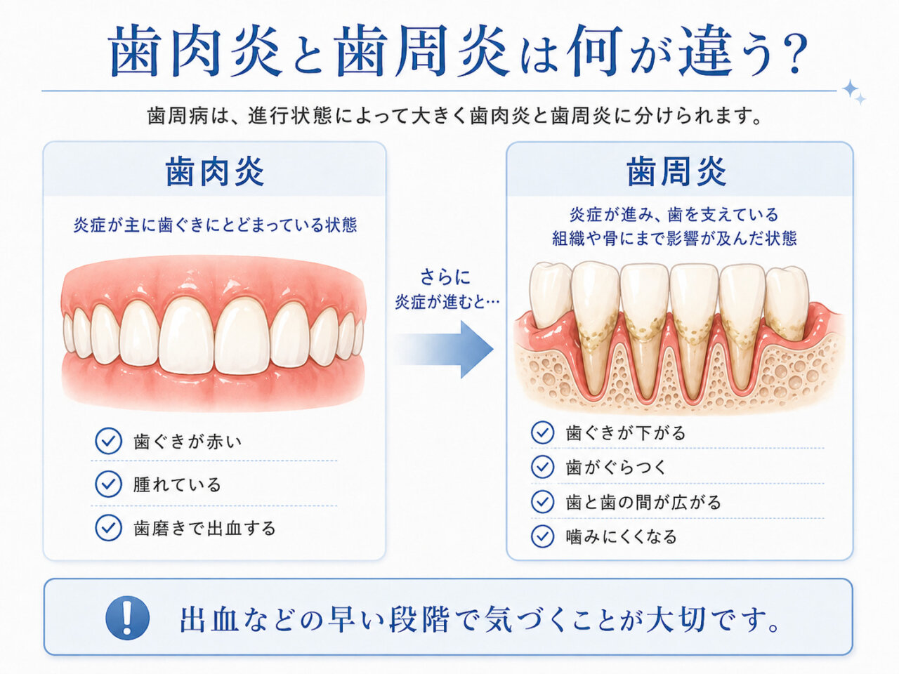 歯肉炎と歯周炎の違いを歯ぐきの炎症や歯を支える骨の状態から比較した画像