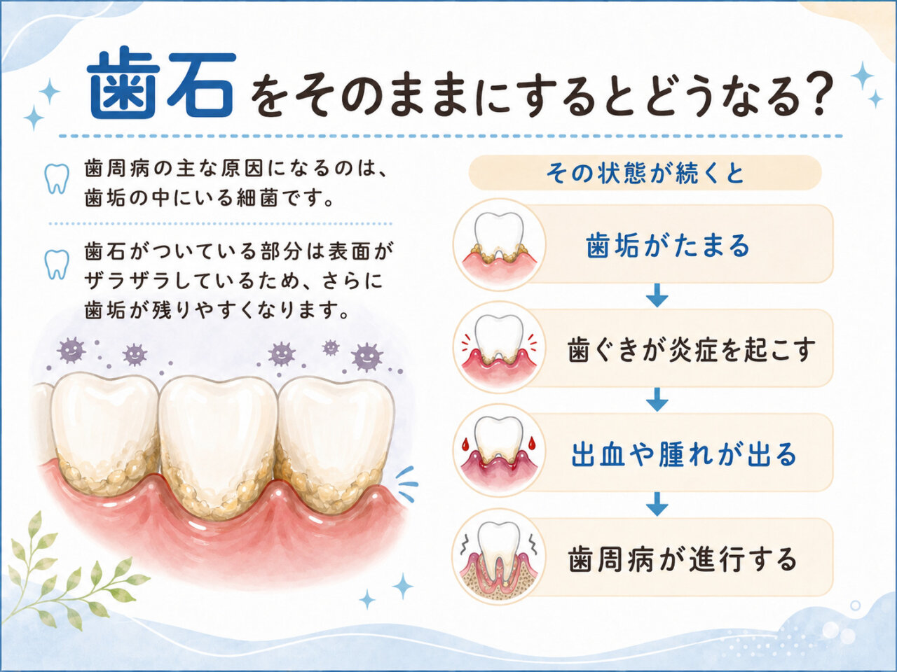 歯垢がたまり歯ぐきの炎症から歯周病へ進行する流れを示したイラスト